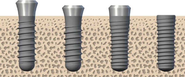 Individuelle Implantatdesigns für individuelle Implantat Lösungen